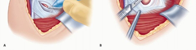 Illustration 23 for Bankart Repair & Inferior Capsular Shift: Solving Shoulder Instability