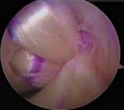 Illustration 19 for Cruciate Ligament Repair: Definitive Guide to Treatment & Recovery
