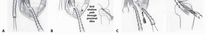 Illustration 38 for Treatment for Congenital Femoral Deficiency: What You Need to Know