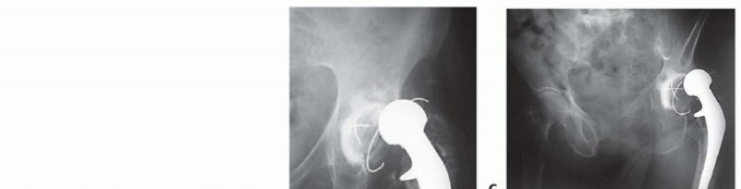 Hip Reimplantation Surgery: The Solution for Infected Implants