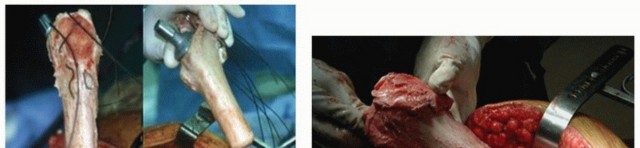 Illustration 20 for Allograft Prosthetic Composite: Mastering Proximal Femur Reconstruction