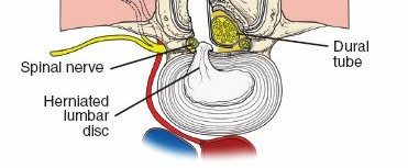Illustration 2 for Minimally Invasive Posterior Approach: Techniques, Benefits & Recovery