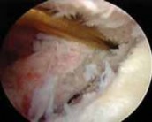 Illustration 16 for Regain Stability: Anterior Shoulder Instability Arthroscopic Fix