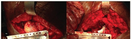 Illustration 8 for Extensively Porouscoated Stems: Proven Success & Superior Fixation