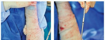 Illustration 12 for Cement in Cement Revision: Simplifying Complex Hip Revisions