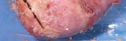 Illustration 61 for Navigating Early THA for Fractures of the Acetabulum