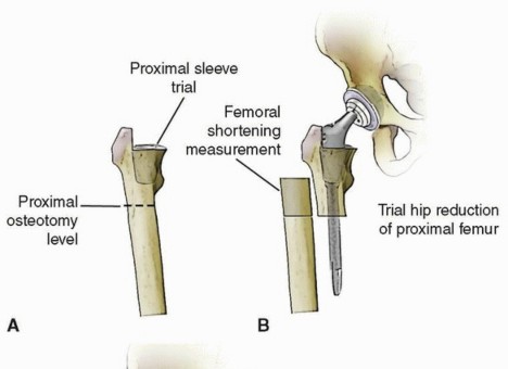 Illustration 4 for Mastering Femoral Head Autograft in DDH Hip Reconstruction
