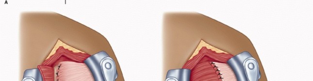 Illustration 28 for Mastering the Treatment of Recurrent Posterior Shoulder Instability