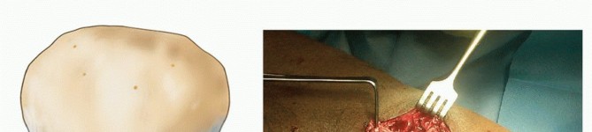 Swift Repair of Acute Patella Tendon Tears for Full Recovery