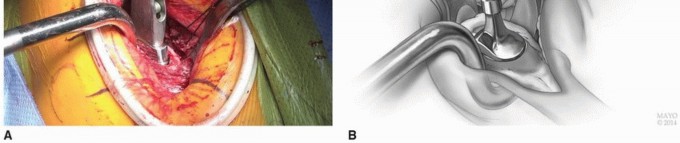 صورة طبية: النهج الأمامي لاستبدال مفصل الورك الكلي: ثورة في جراحة الورك مع الأستاذ الدكتور محمد هطيف في صنعاء