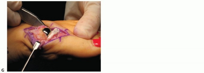 Illustration 65 for End Articular Cartilage Loss: Arthrosurface HemiCAP Resurfacing