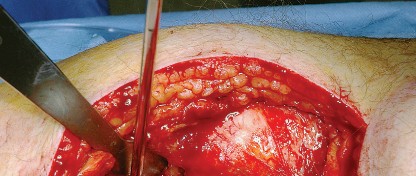 Illustration 27 for Unlock the Figure Posterior Approach to the Hip