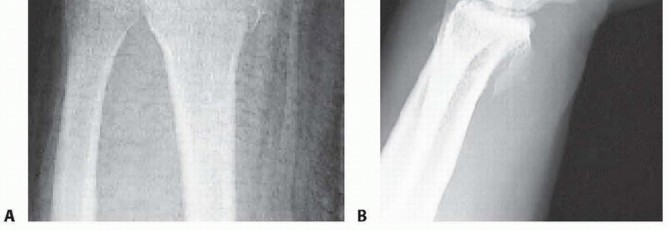 Illustration 12 for Arthroscopic Fixation: Effectively Treating Radial Styloid Fragments