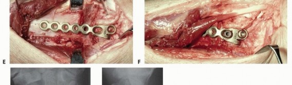 Illustration 19 for Precision Correction for Distal Radius Malunion