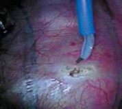 Illustration 15 for Mastering Anterior Interbody Arthrodesis with Instrumentation for Scoliosis