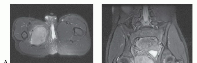 Illustration 5 for Optimizing Adductor Muscle Group Resection for Limb Preservation