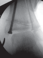 Illustration of hemiepiphysiodesis for ankle - Dr. Mohammed Hutaif