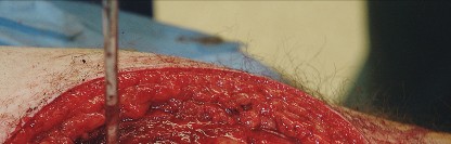 Illustration 62 for Unlock the Figure Posterior Approach to the Hip