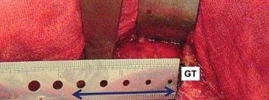 صورة طبية: إتقان توازن الأنسجة الرخوة لمفصل ورك صناعي مثالي: دليل شامل للمرضى مع الأستاذ الدكتور محمد هطيف