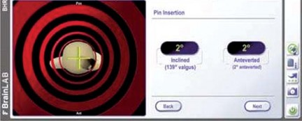 Illustration 40 for Minimizing Risks: Computer Navigation in Hip Resurfacing Arthroplasty