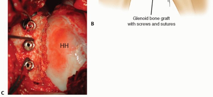 Illustration 25 for Glenoid Bone Graft for Anterior Shoulder Instability: Restore Stability