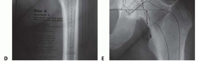 Illustration 4 for Cemented Total Hip: A Successful & Evidence-Based Solution