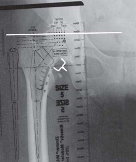 Illustration 31 for Kinectiv® Stem: Modular Necks for Primary THA Success