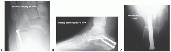 Illustration 27 for Lateral Column Lengthening: Relieve Flatfoot Pain & Correct Deformity