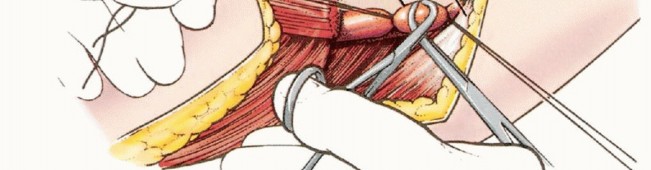 Illustration 24 for Anterior Flap Hemipelvectomy: Leveraging fig tech fig for Difficult Tumors