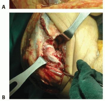 Illustration 6 for Radial Head & Neck Fractures: Mastering ORIF for Best Results