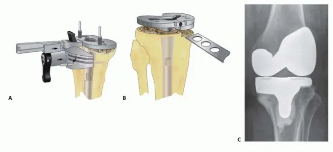 علاج نقص عظم الساق في مراجعة مفصل الركبة: حلول الدعامات المتقدمة مع الأستاذ الدكتور محمد هطيف في صنعاء