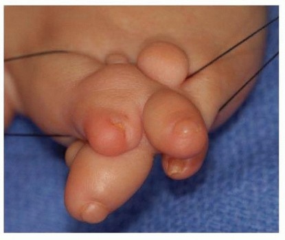 Amniotic Band Syndrome: Your Guide to Treatment, courtesy of Shriners Hospital