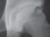 Illustration 22 for Resolving Femoral Head Neck Impingement: Arthroscopic FAI Solutions