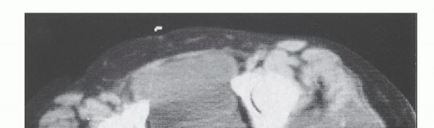 Illustration 4 for Anterior Flap Hemipelvectomy: Leveraging fig tech fig for Difficult Tumors