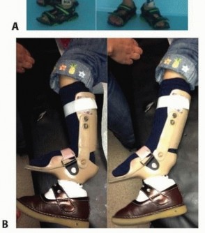 Illustration 11 for Treatment for Congenital Femoral Deficiency: What You Need to Know