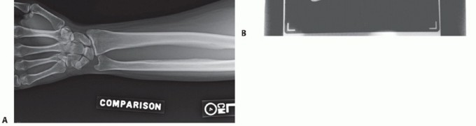 Illustration 20 for Radial Head & Neck Fractures: Mastering ORIF for Best Results