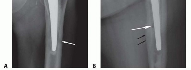 Illustration 6 for Resection Arthroplasty & Spacers: Optimizing Time of Reimplantation
