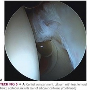 Illustration 107 for Precision Hip Arthroscopy: Unlock Access to the Peripheral Compartment