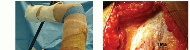 Illustration 14 for Restore Shoulder Function with Latissimus Dorsi Tendon Transfer