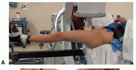 Illustration 7 for Pediatric Femoral Nailing: Targeting the Right aspect of the greater Trochanter