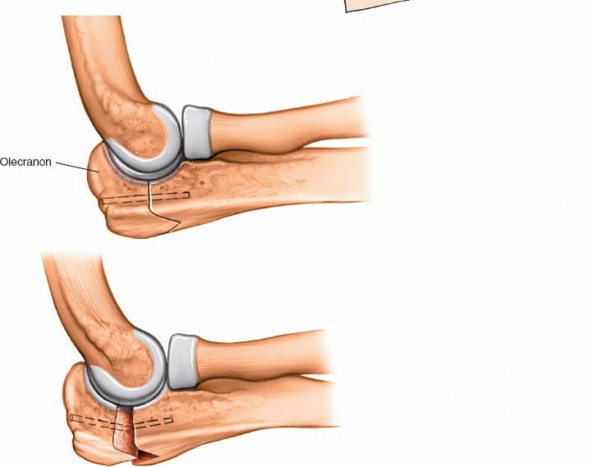 Illustration 8 for Mastering Elbow Approaches: Applied Surgical Anatomy for Precision