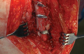 Illustration 99 for Femoral Stem Revision: Posterior Approach for Better Outcomes