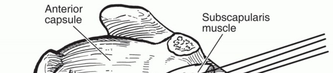 Illustration 11 for Latarjet for Instability: Bone Loss Solutions, Per Burkhart SS, Lo