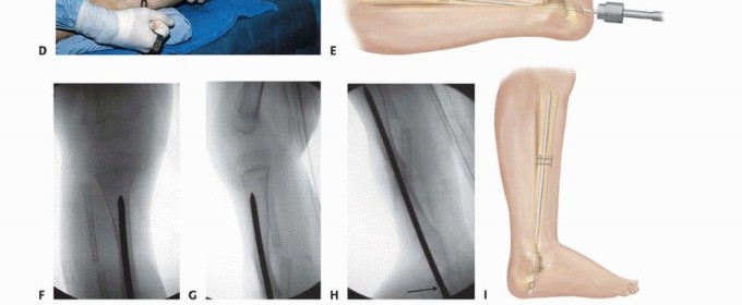 Illustration 9 for Williams Rod: Achieve Stability for Pseudarthrosis within the Tibia