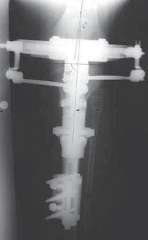Illustration 15 for Conquering Adolescent Blount's Disease: A Surgical Guide
