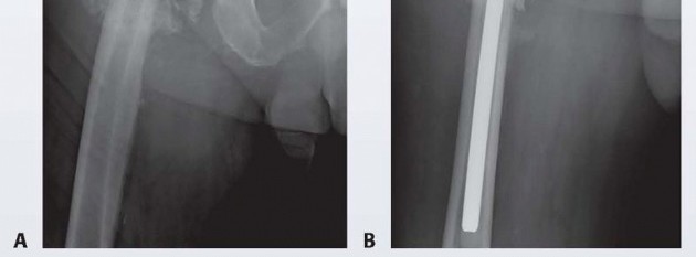 Illustration 16 for Resection Arthroplasty & Spacers: Optimizing Time of Reimplantation