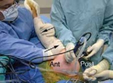 Illustration 13 for Arthroscopic Subscapularis Repair: The lo iky brady Method for Stability