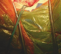 Illustration 7 for Mastering Direct Anterior Approach Hip Arthroplasty Without a Traction Table