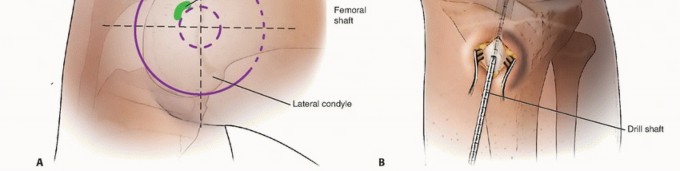 Illustration 17 for Optimizing ACL Reconstruction for Skeletally Immature Patients