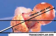 Increased Femoral Anteversion: A Proximal Femoral Rotational Osteotomy